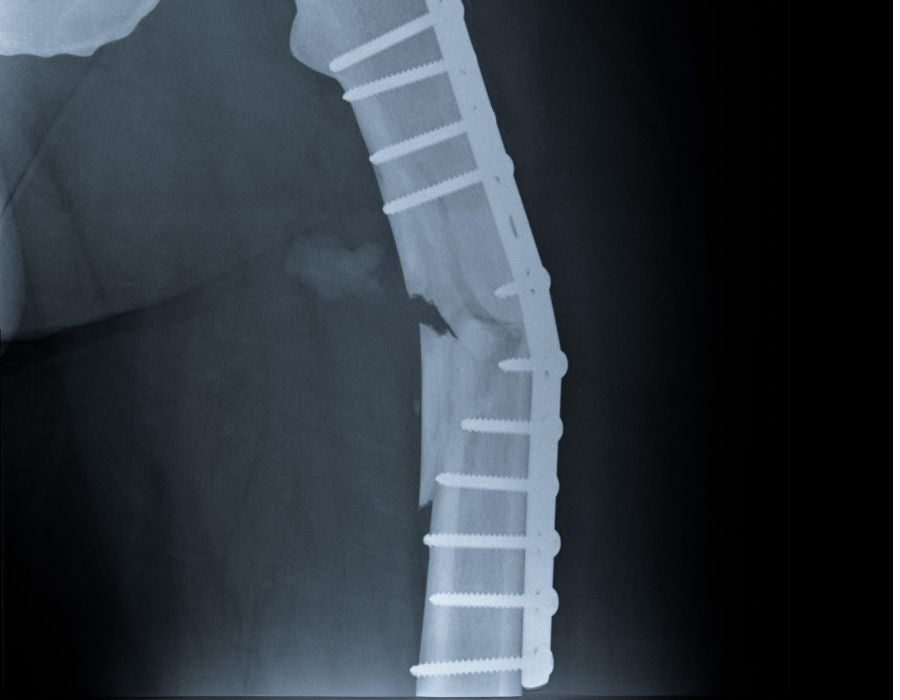 Understanding Osteoporosis: The Silent Threat to Bone Health